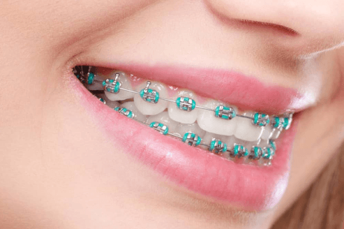 aligner360