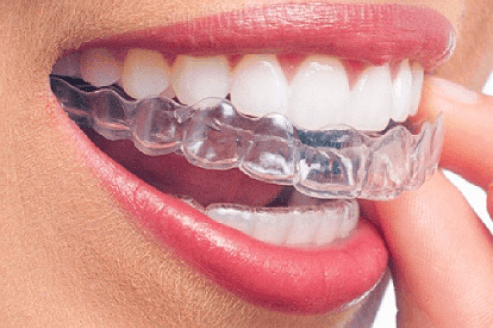 Aligner360 Aligners